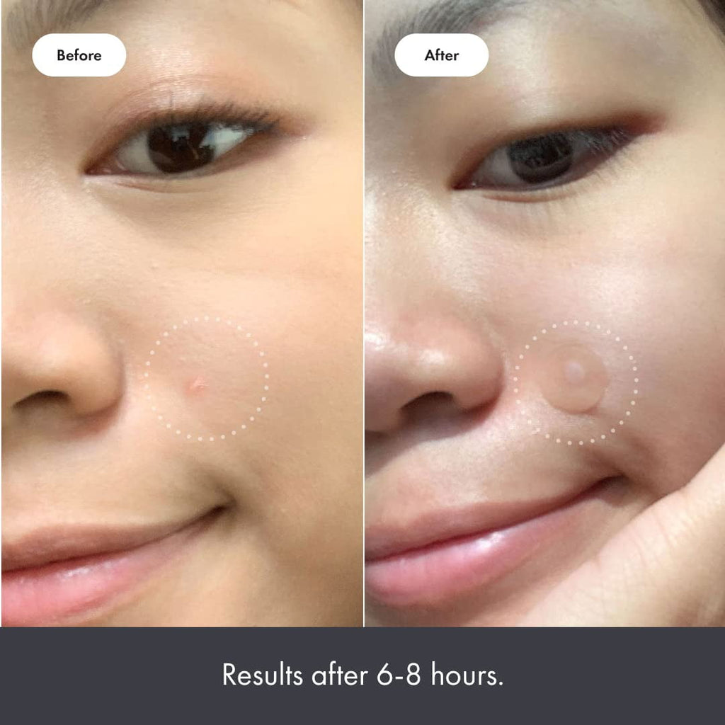 Mighty Patch™ Original from Hero Cosmetics - Hydrocolloid Acne Pimple Patch (27 Patches)